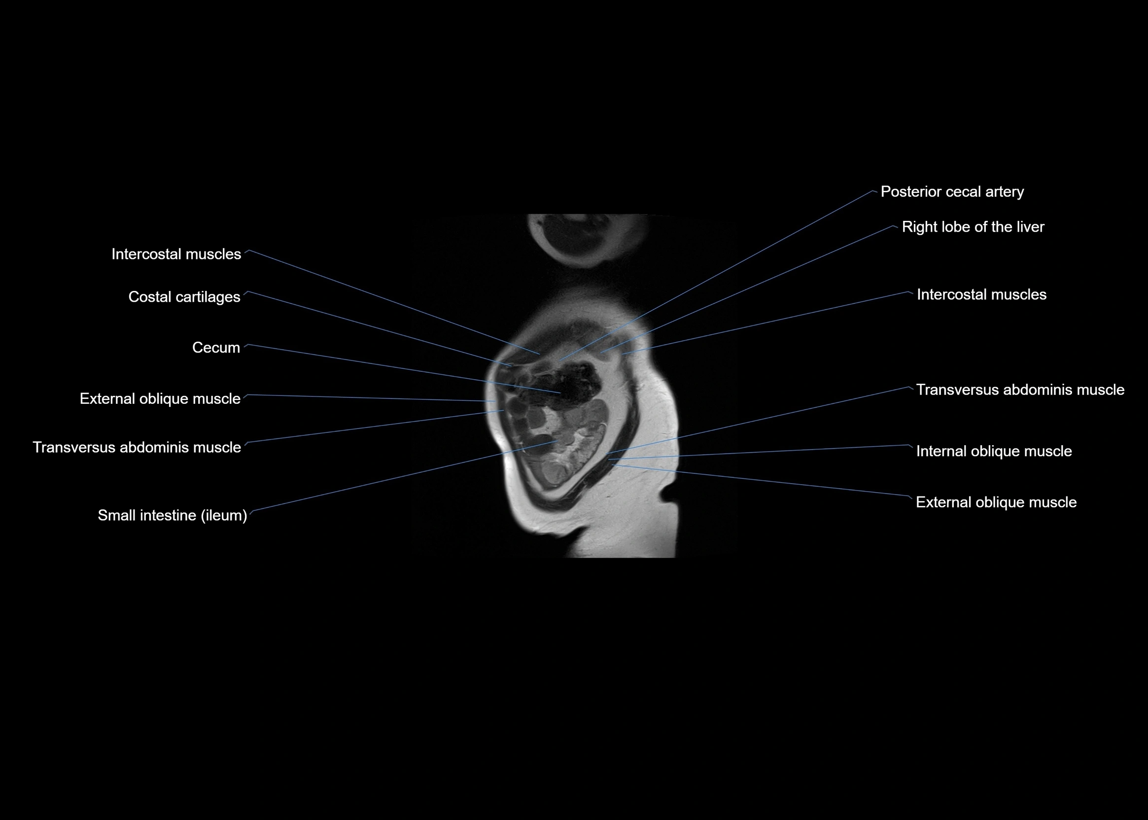 MRI abdomen sagittal cross sectional anatomy  radiology  image-img-00001-00007.webp